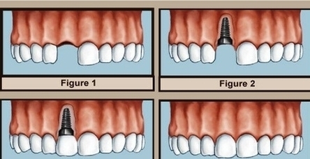 Dentalimplantsdental Image