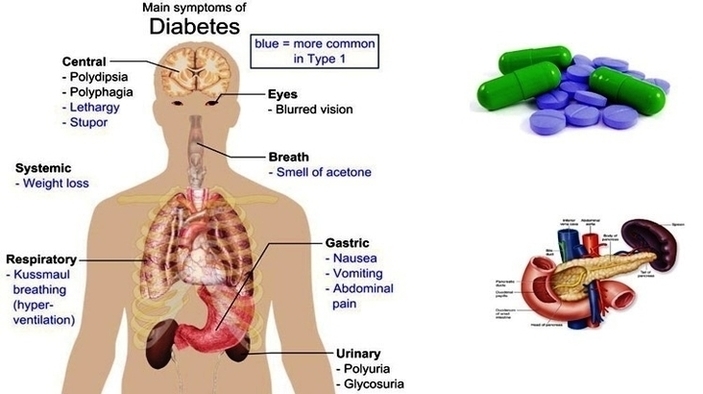 Diabetes Insipidus Treatment Image