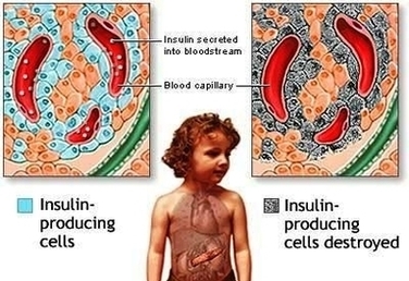 Diabetes Mellitus In Children Image