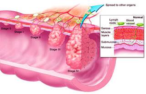 Diagram Colon Cancer Image