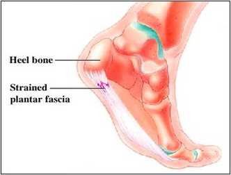 Diagram Easy Plantar Fasciitis Stretches Foot Image