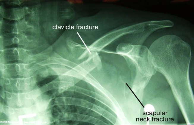 Diagram Floating Shoulder Xray Image