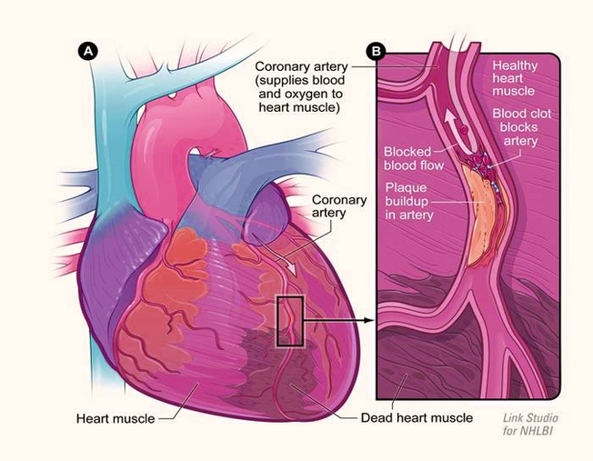 Diagram Heart Attack Large Image