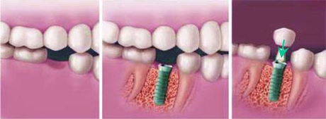 Diagram How Do Dental Implants Work Image