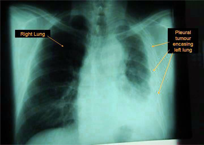 Diagram Lung Mesothelioma Image