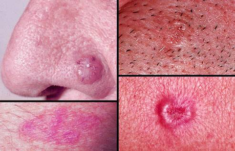 Diagram Of Collage Of Basal Cell Carcinoma Image