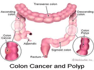 Diagram Of Colon Cancer And Polyp Image