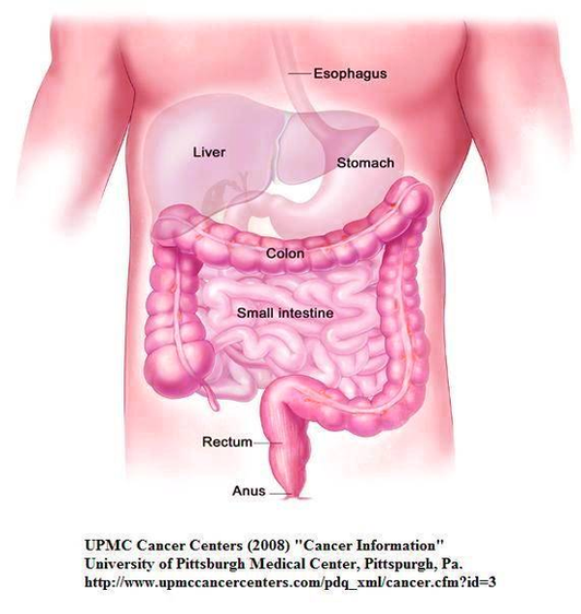Diagram Of Cystic Fibrosis Patients Need Early Colon Cancer Screening Image