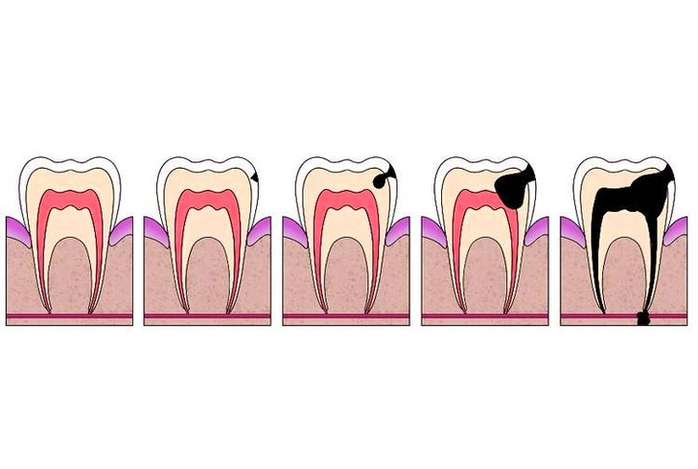 Diagram Of Dental Cavity Image