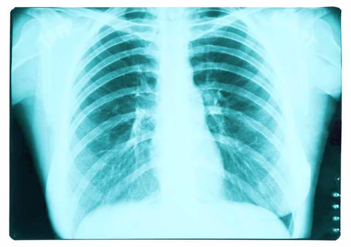Diagram Of Early Detection Copd Could Help Prevent Lung Cancer Image