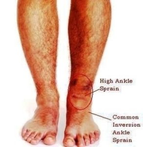 Diagram Of High Ankle Sprain Image - Graph Diagram