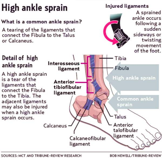 Diagram Of High Ankle Sprain Image
