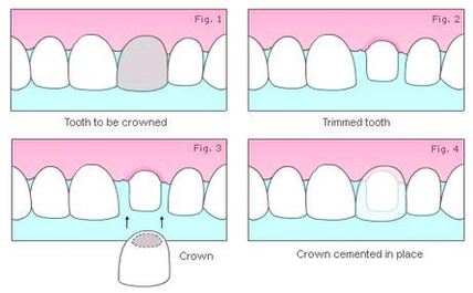 Diagram Of Hornsby Dental Crowns Figure Image