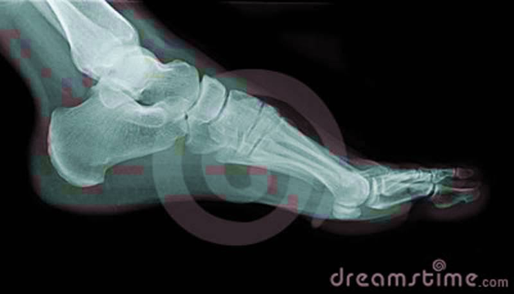 Diagram Of Left Foot Side Ray Image