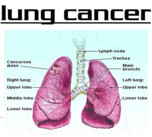 Diagram Of Lung Cancer New Image - Graph Diagram