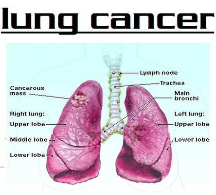 Diagram Of Lung Cancer New Image