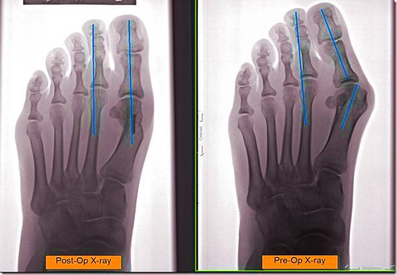 Diagram Of Post Op Ray Of Painful Bunion Thumb Image