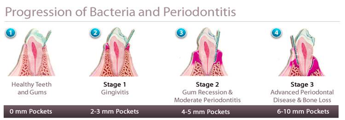 Diagram Of Progression Of Gum Disease Image