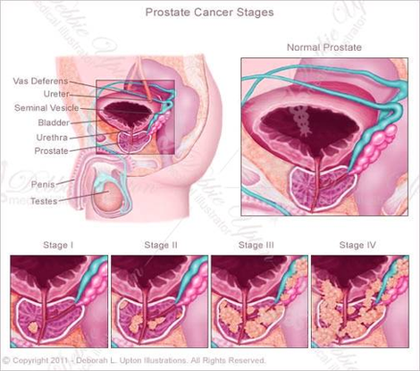 Diagram Of Prostate Cancer Image