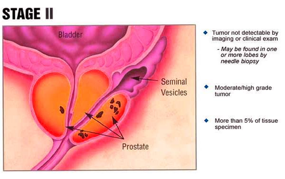 Diagram Of Stage Ii Prostate Cancer Image