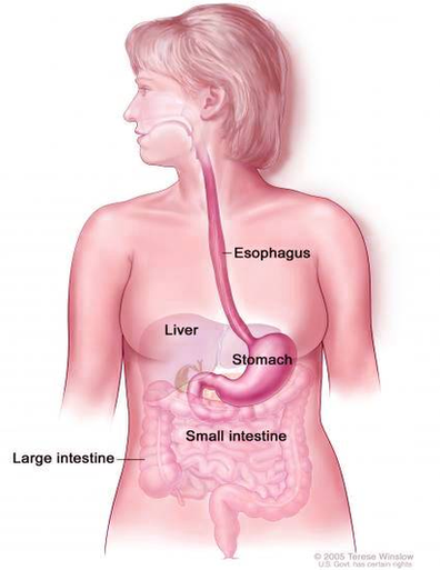 Diagram Of Stomach Cancer Gastric Image