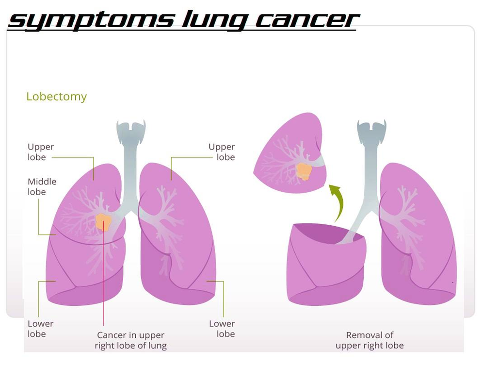 Diagram Of Symptoms Lung Cancer Image