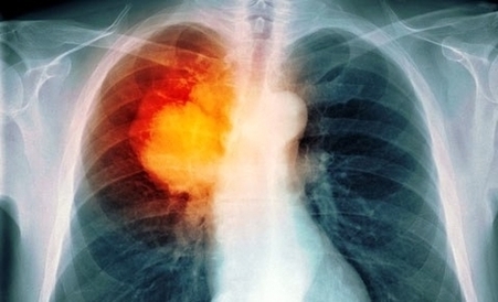 Diagram Princ Rm Lung Cancer Xray Image