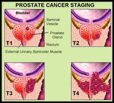 Diagram Prostate Cancer Stages Image