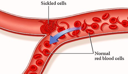 Diagram Sickle Cell Disease Image