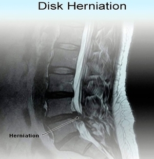 Disc Herniation Image