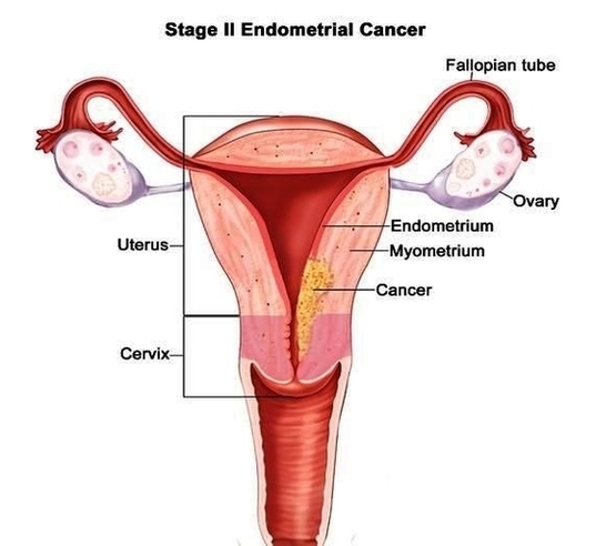 Endometrial Cancer Metastasis To Bone Jvrucwgo Image