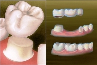 Fixed Teeth Replacement Image