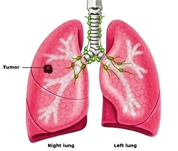 Fluid In Lung Causes Cancer Symptoms Smoking Stages Ii Image