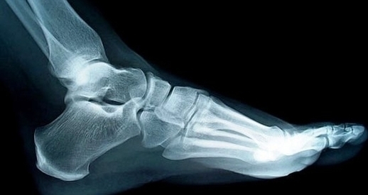 Foot Bones Xray Ed Image