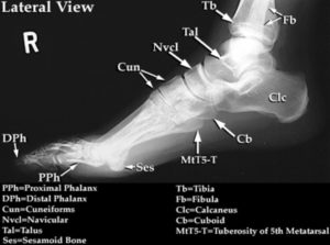 Foot Normal Lat Xray Image - Graph Diagram