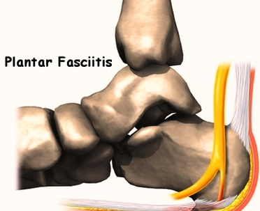 Foot Plantar Fasciitis Intro Image
