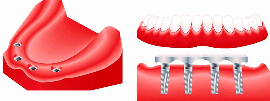 Full Mouth Dental Restoration Photo Image