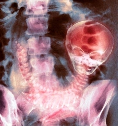 Full Term Foetus Ray Spl Image