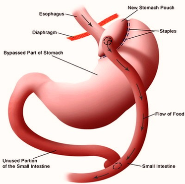 Gastric Bypass Diagram Image