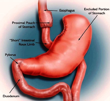 Gastric Bypass Image