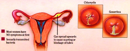 Gonnorhea And Chlamydia Diagram Image