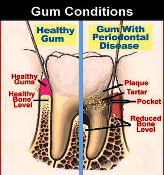 Gum Diagram Image