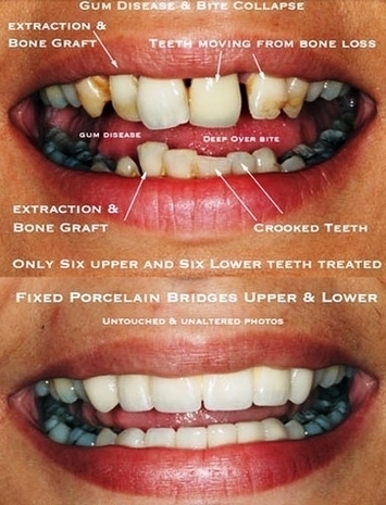 Gum Disease Closeup Image