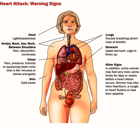 Heart Attack Diagram Image