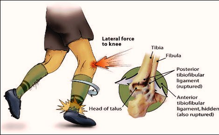 High Ankle Sprain Cause Diagram Image