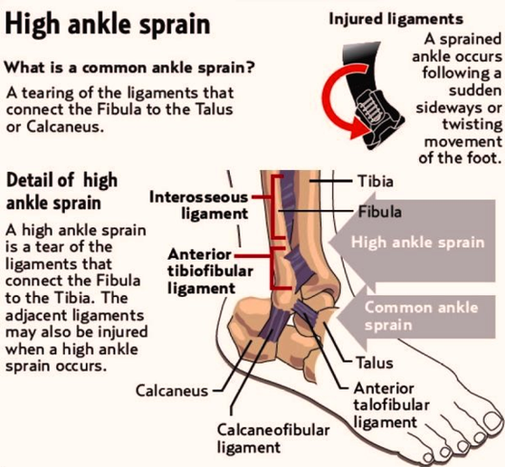 High Ankle Sprain Illustration Photos Image