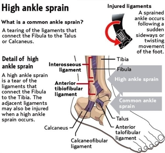 High Ankle Sprain Image