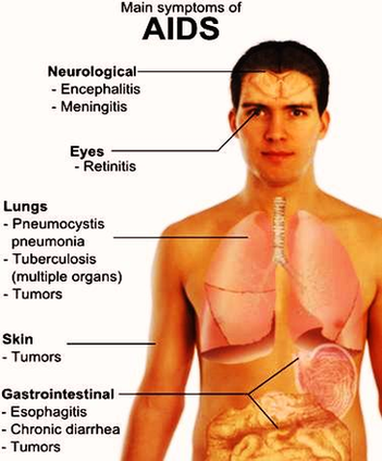 Hiv Aids Symptoms Figure Image