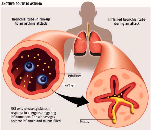 How Asthma Happens Diagram Image