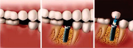How Do Dental Implants Work Image